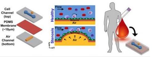 在芯片上實(shí)現(xiàn)動(dòng)脈粥樣硬化的模擬，并在心臟病發(fā)作前評(píng)估血管的狹窄和血液的健康狀況